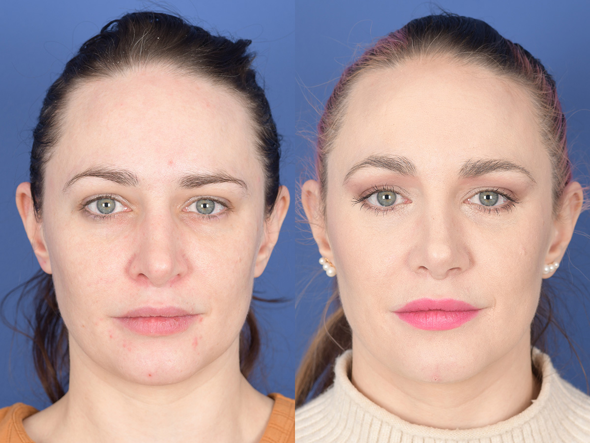 Revision Rhinoplasty Before and After | Weber Facial Plastic Surgery