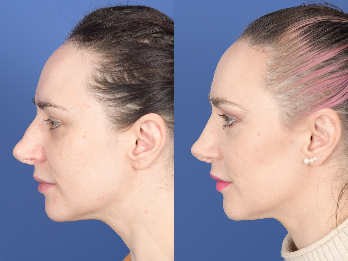 Revision Rhinoplasty Before and After | Weber Facial Plastic Surgery