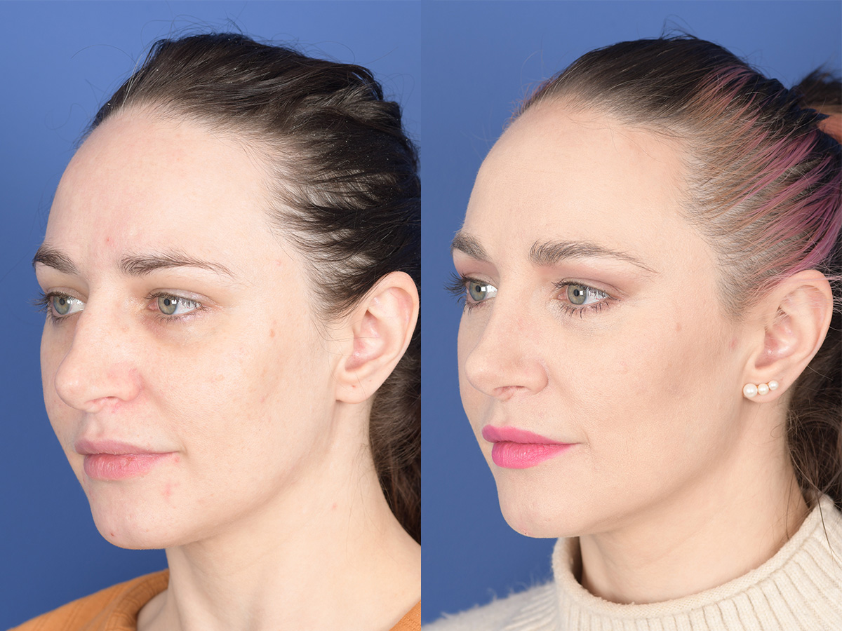 Revision Rhinoplasty Before and After | Weber Facial Plastic Surgery