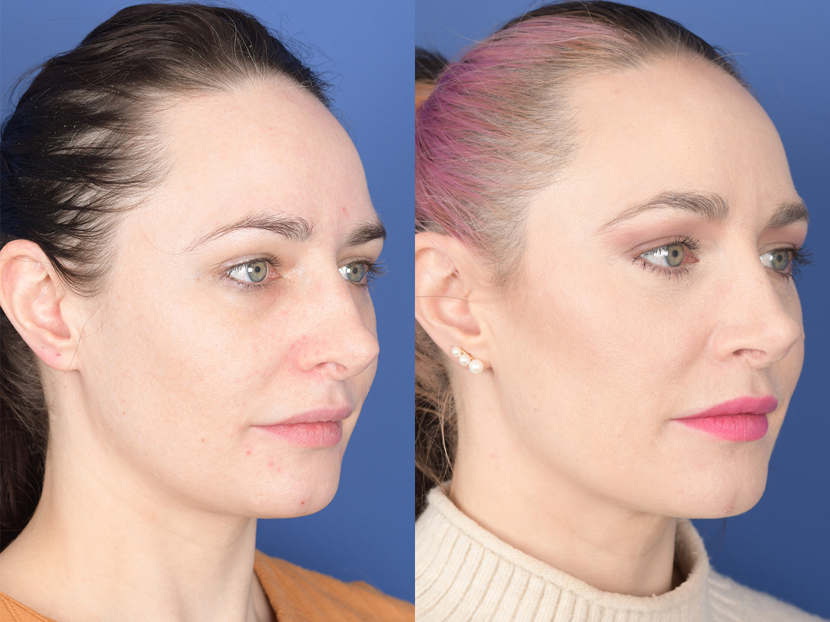 Revision Rhinoplasty Before and After | Weber Facial Plastic Surgery