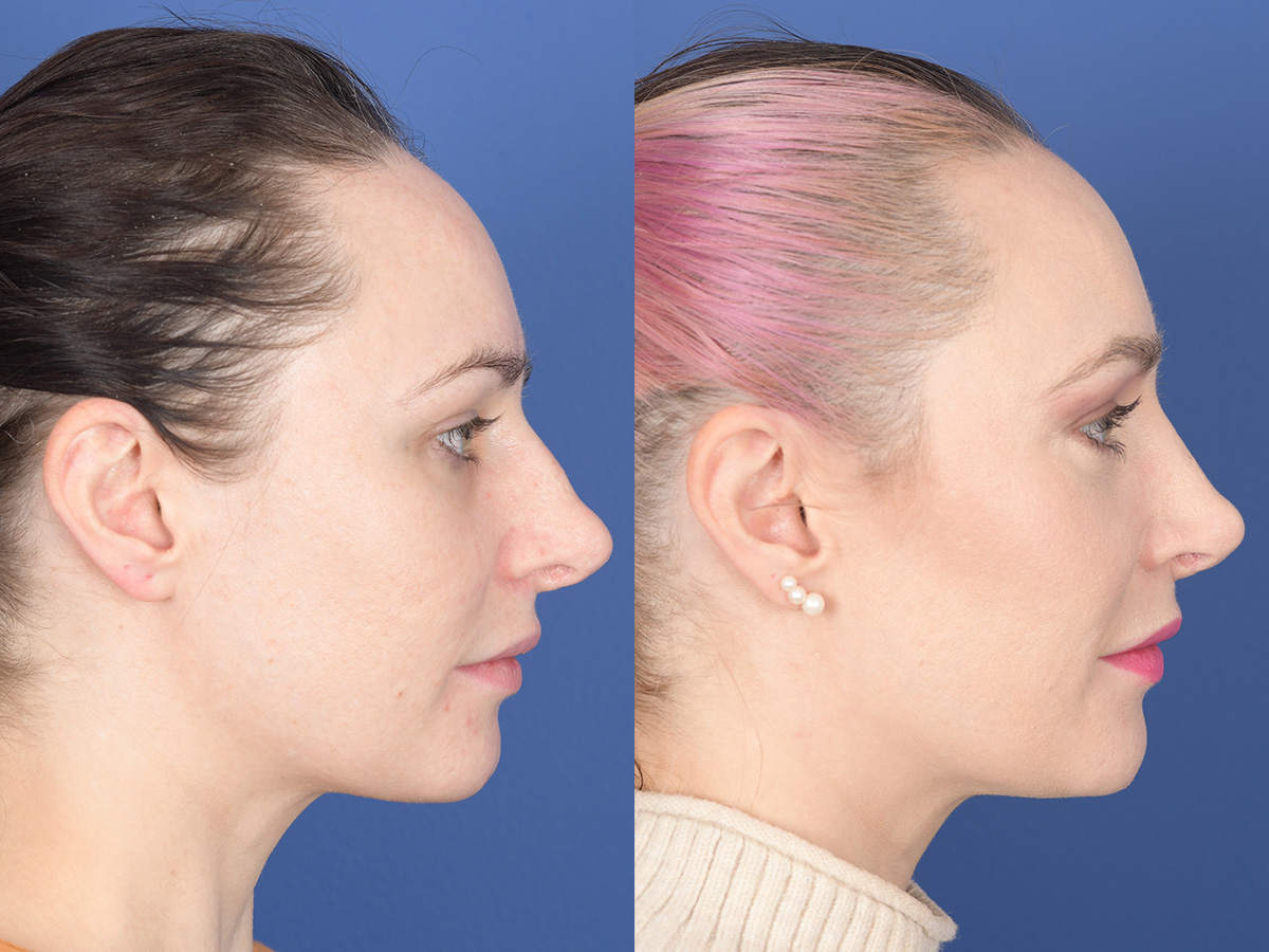 Revision Rhinoplasty Before and After | Weber Facial Plastic Surgery