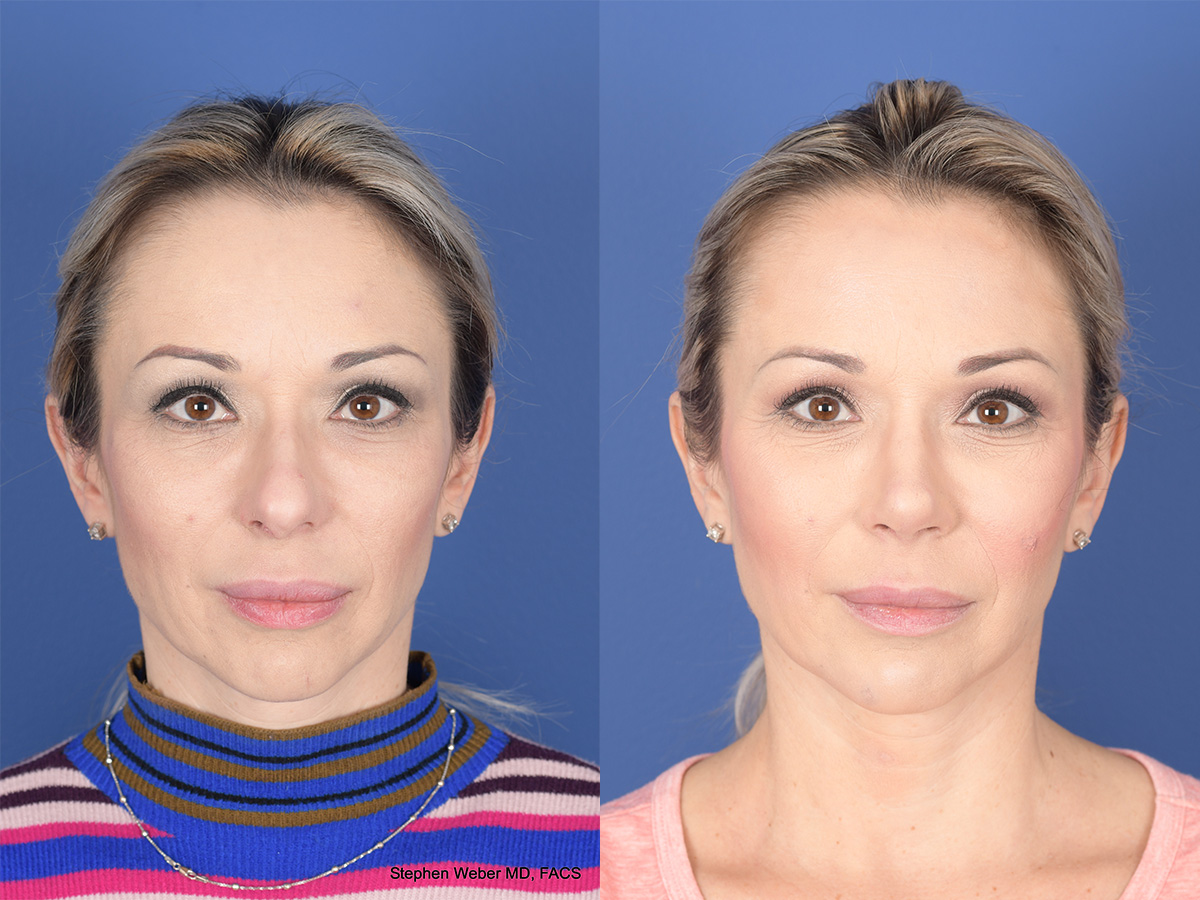 Revision Rhinoplasty Before and After | Weber Facial Plastic Surgery