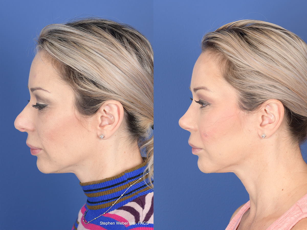 Revision Rhinoplasty Before and After | Weber Facial Plastic Surgery