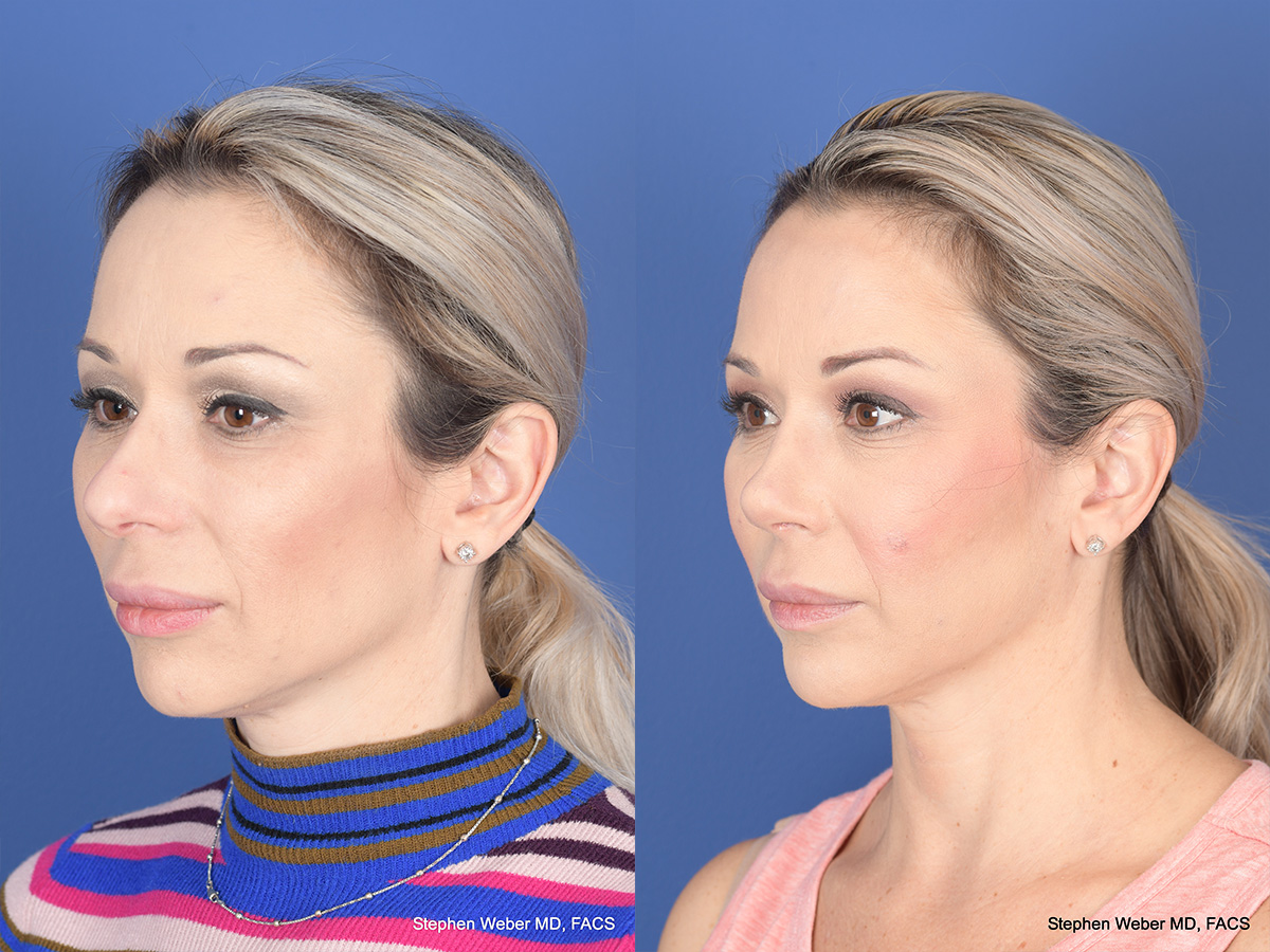 Revision Rhinoplasty Before and After | Weber Facial Plastic Surgery