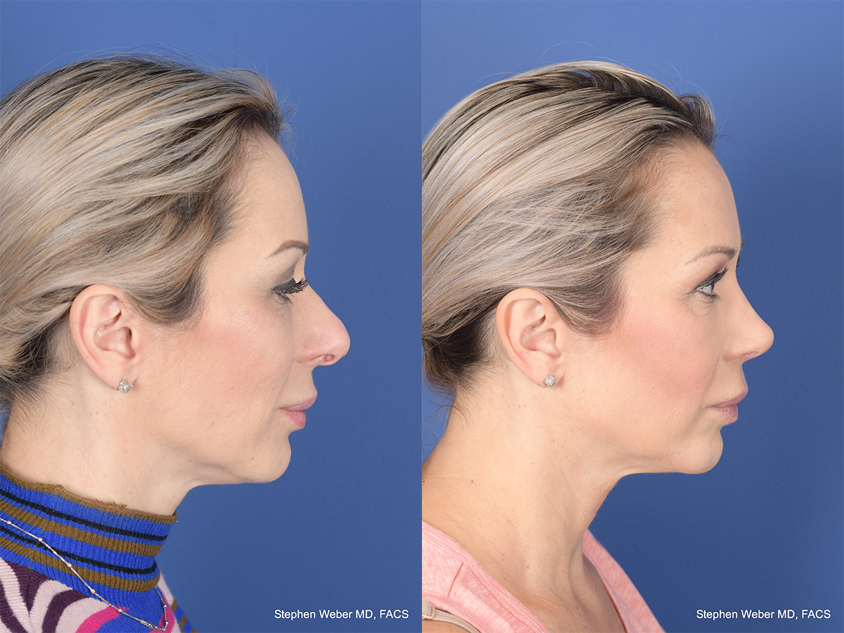 Revision Rhinoplasty Before and After | Weber Facial Plastic Surgery