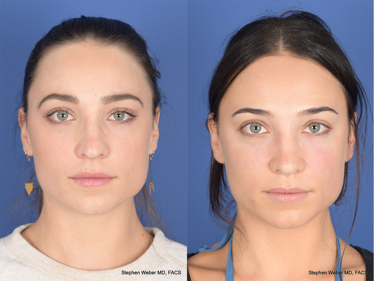 Revision Rhinoplasty Before and After | Weber Facial Plastic Surgery