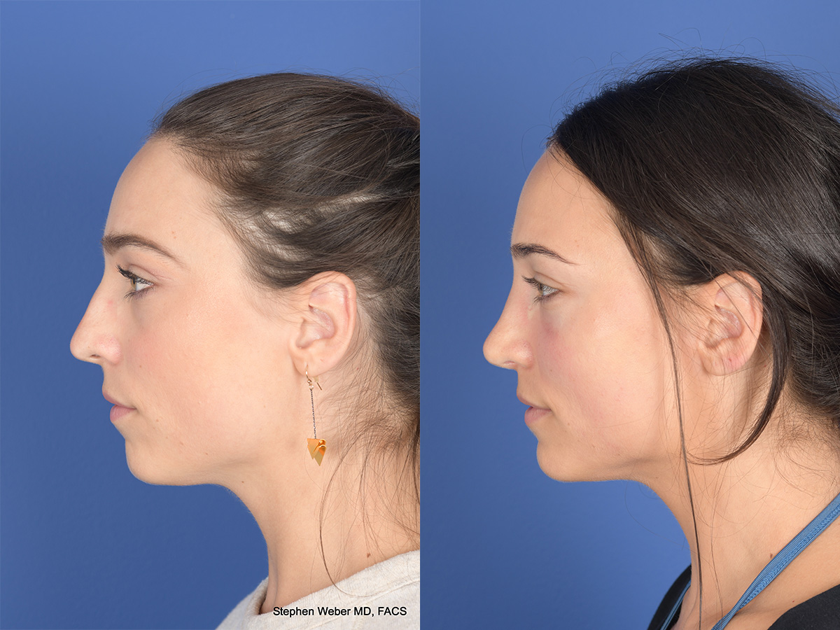 Revision Rhinoplasty Before and After | Weber Facial Plastic Surgery