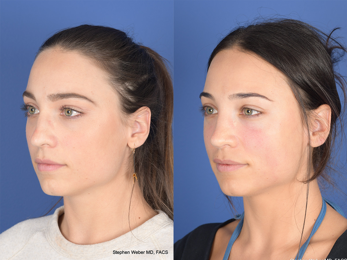 Revision Rhinoplasty Before and After | Weber Facial Plastic Surgery