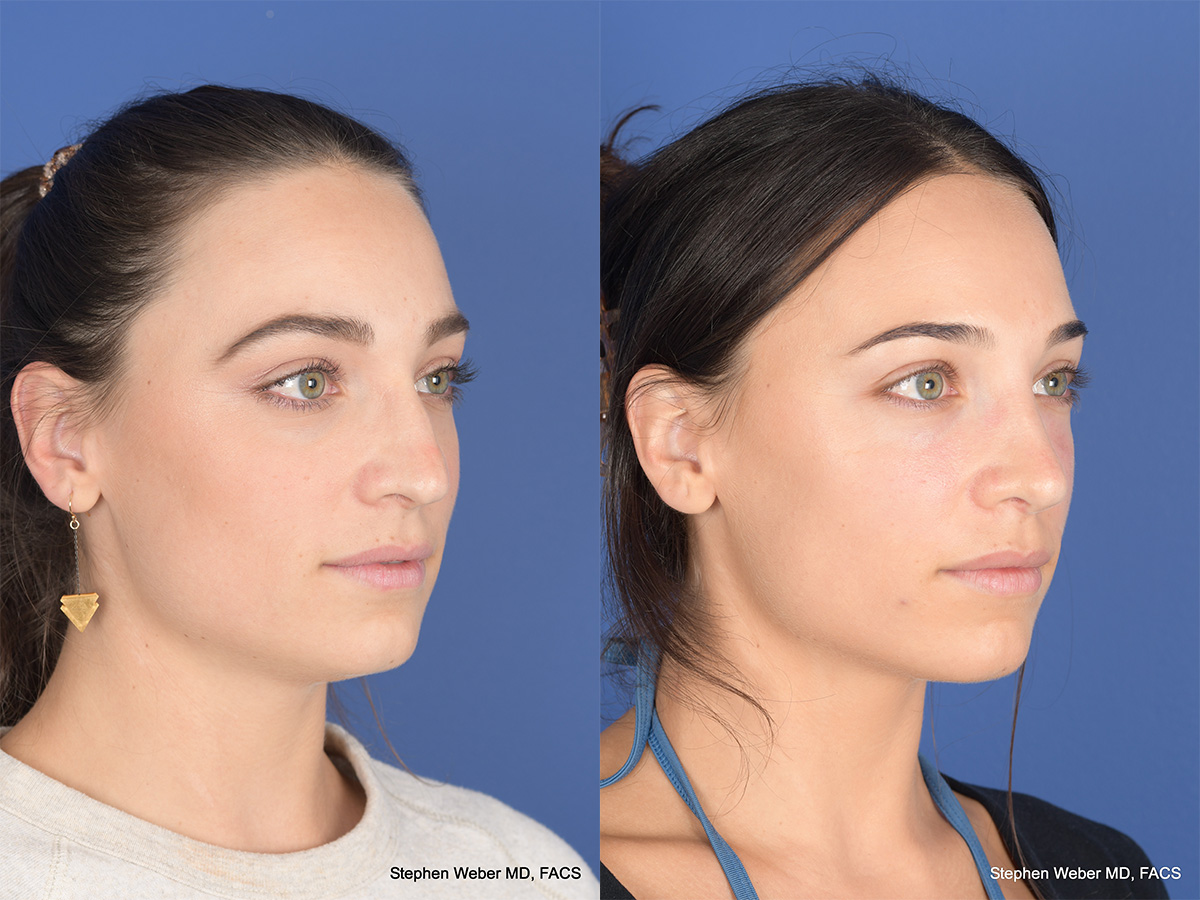 Revision Rhinoplasty Before and After | Weber Facial Plastic Surgery