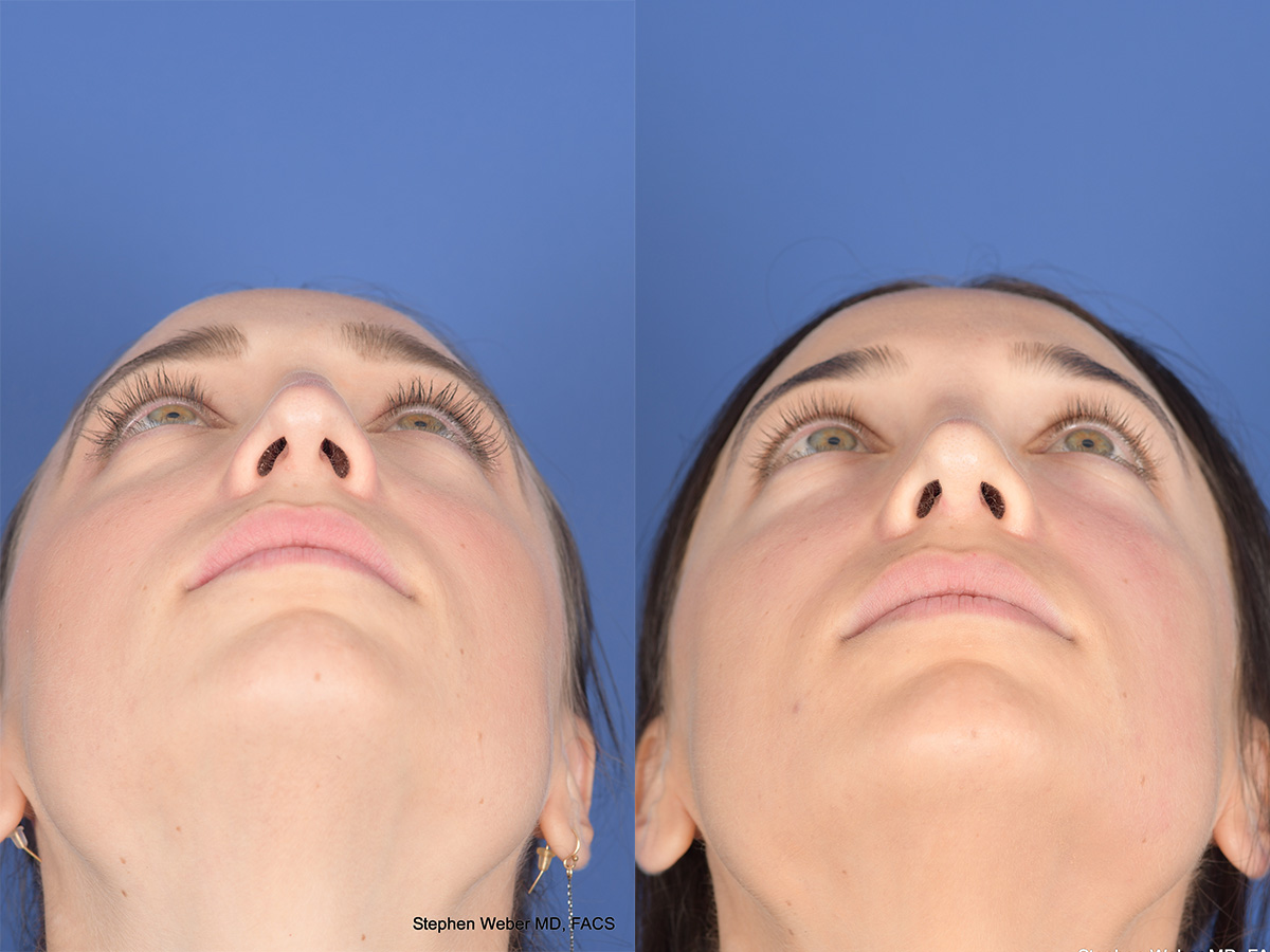 Revision Rhinoplasty Before and After | Weber Facial Plastic Surgery