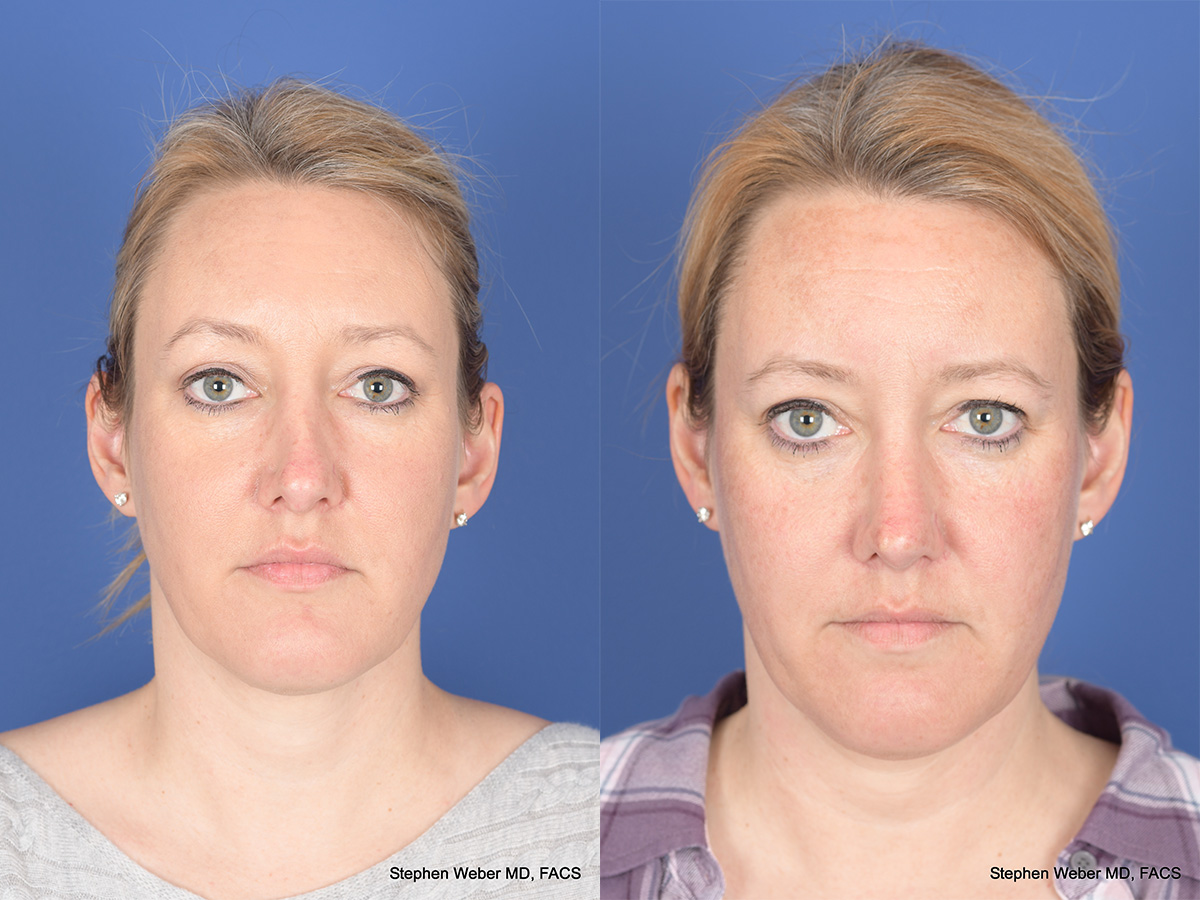 Revision Rhinoplasty Before and After | Weber Facial Plastic Surgery