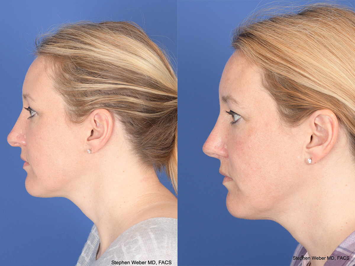 Revision Rhinoplasty Before and After | Weber Facial Plastic Surgery