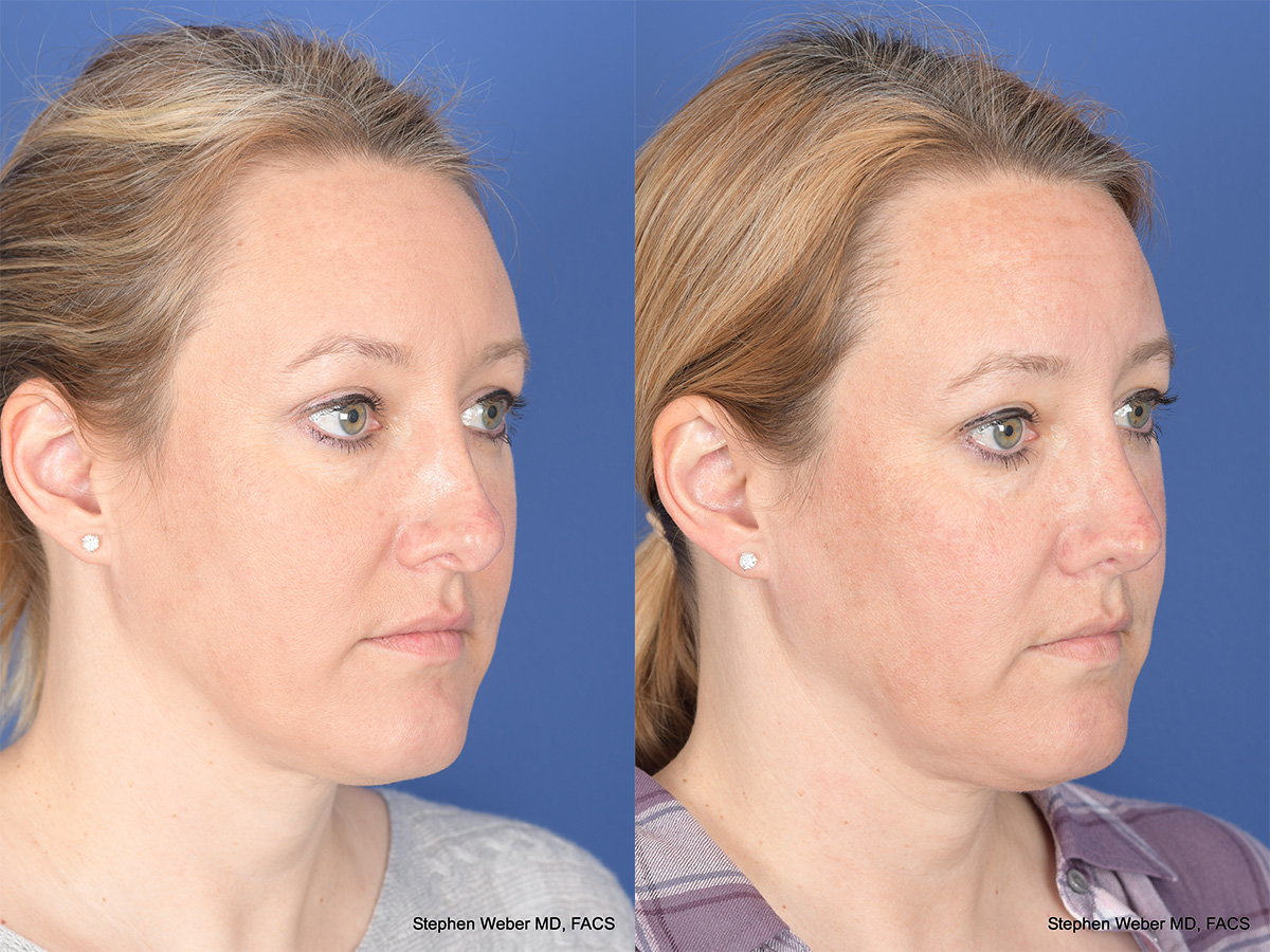 Revision Rhinoplasty Before and After | Weber Facial Plastic Surgery
