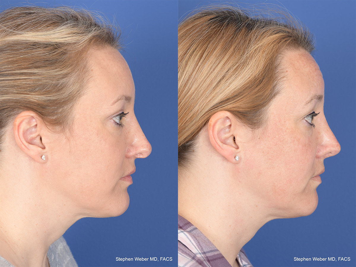 Revision Rhinoplasty Before and After | Weber Facial Plastic Surgery