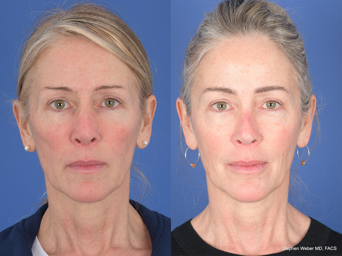 Revision Rhinoplasty Before and After | Weber Facial Plastic Surgery