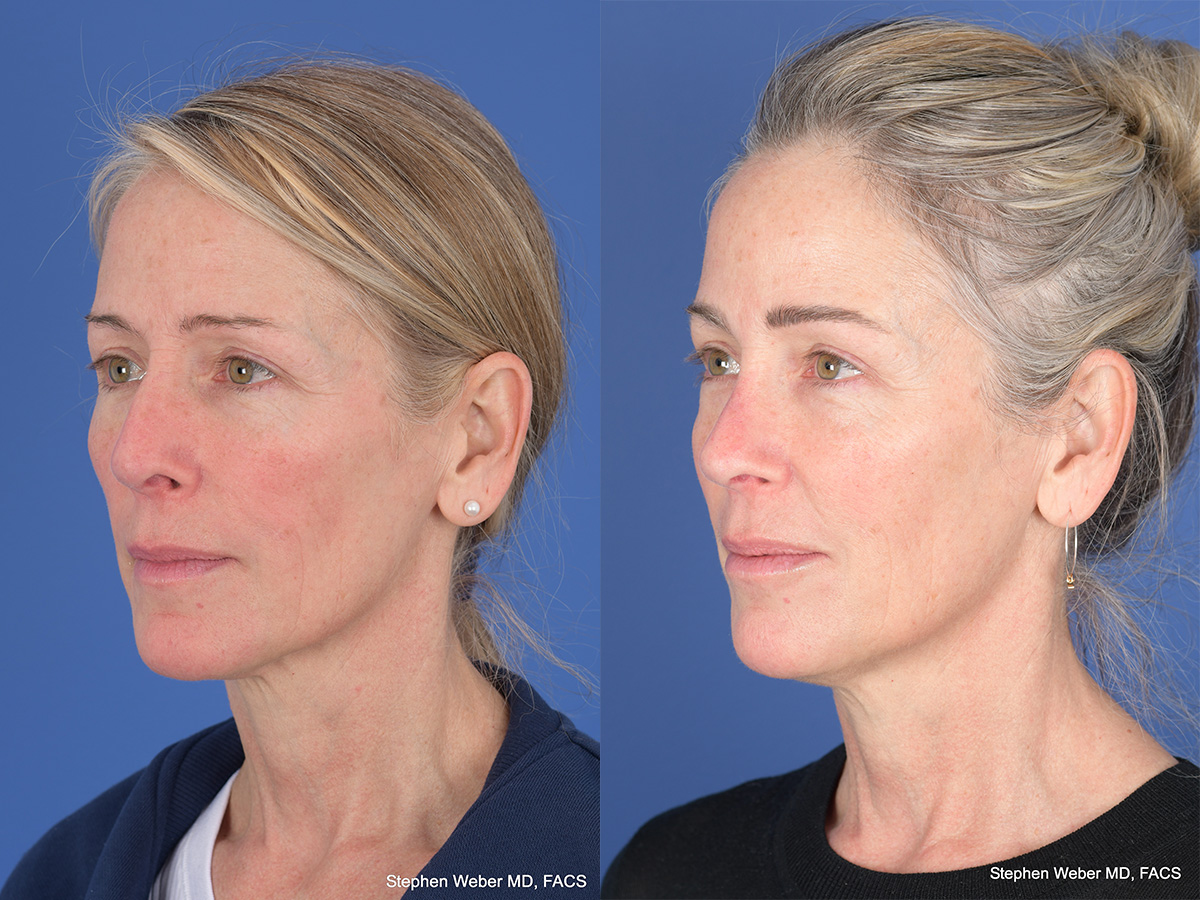 Revision Rhinoplasty Before and After | Weber Facial Plastic Surgery