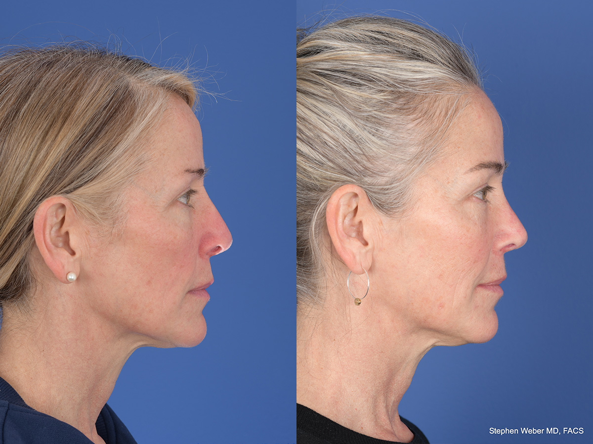 Revision Rhinoplasty Before and After | Weber Facial Plastic Surgery