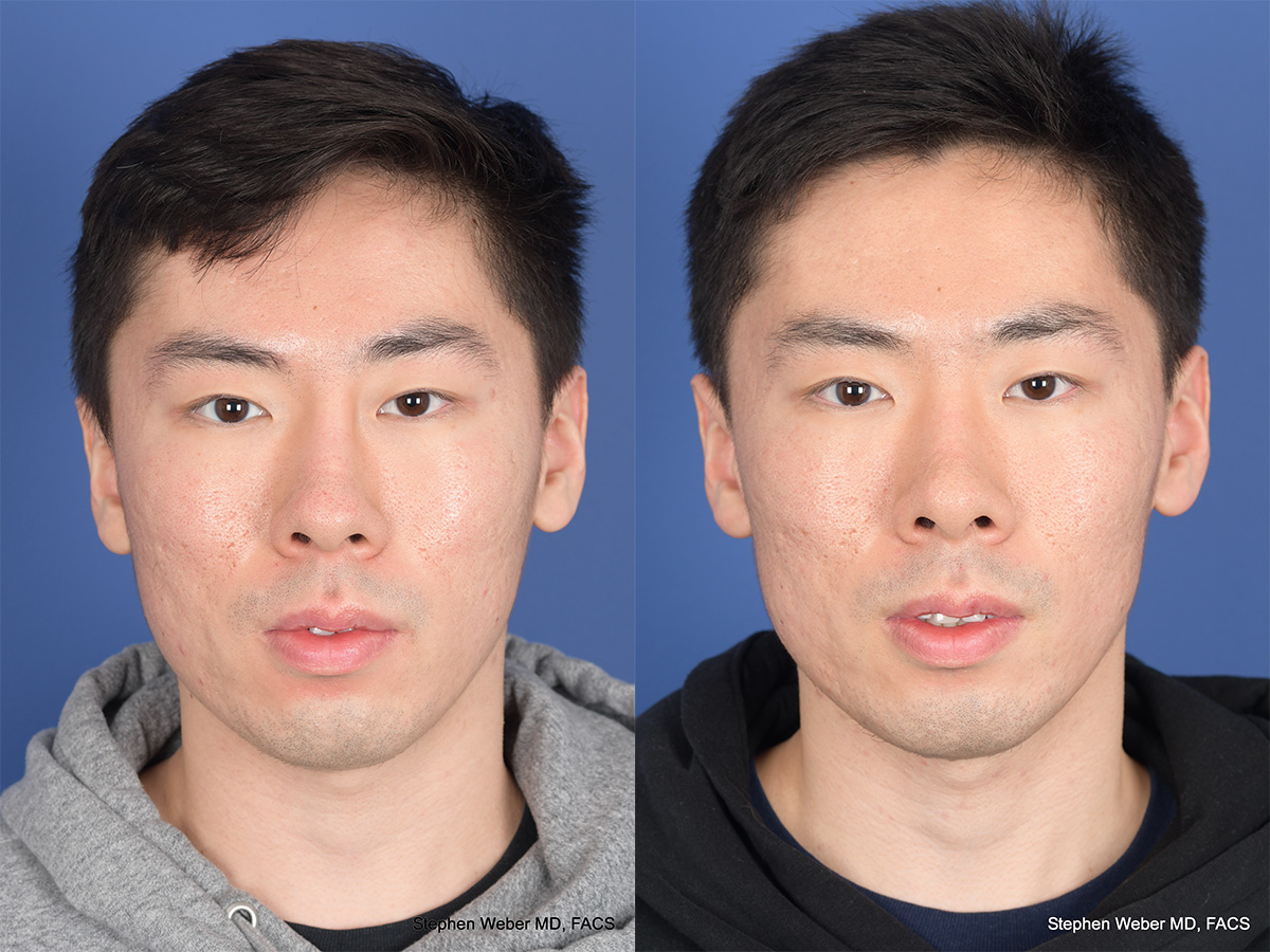Revision Rhinoplasty Before and After | Weber Facial Plastic Surgery