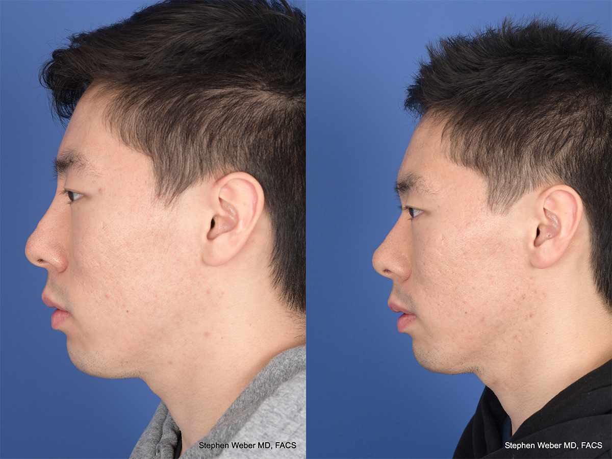 Revision Rhinoplasty Before and After | Weber Facial Plastic Surgery