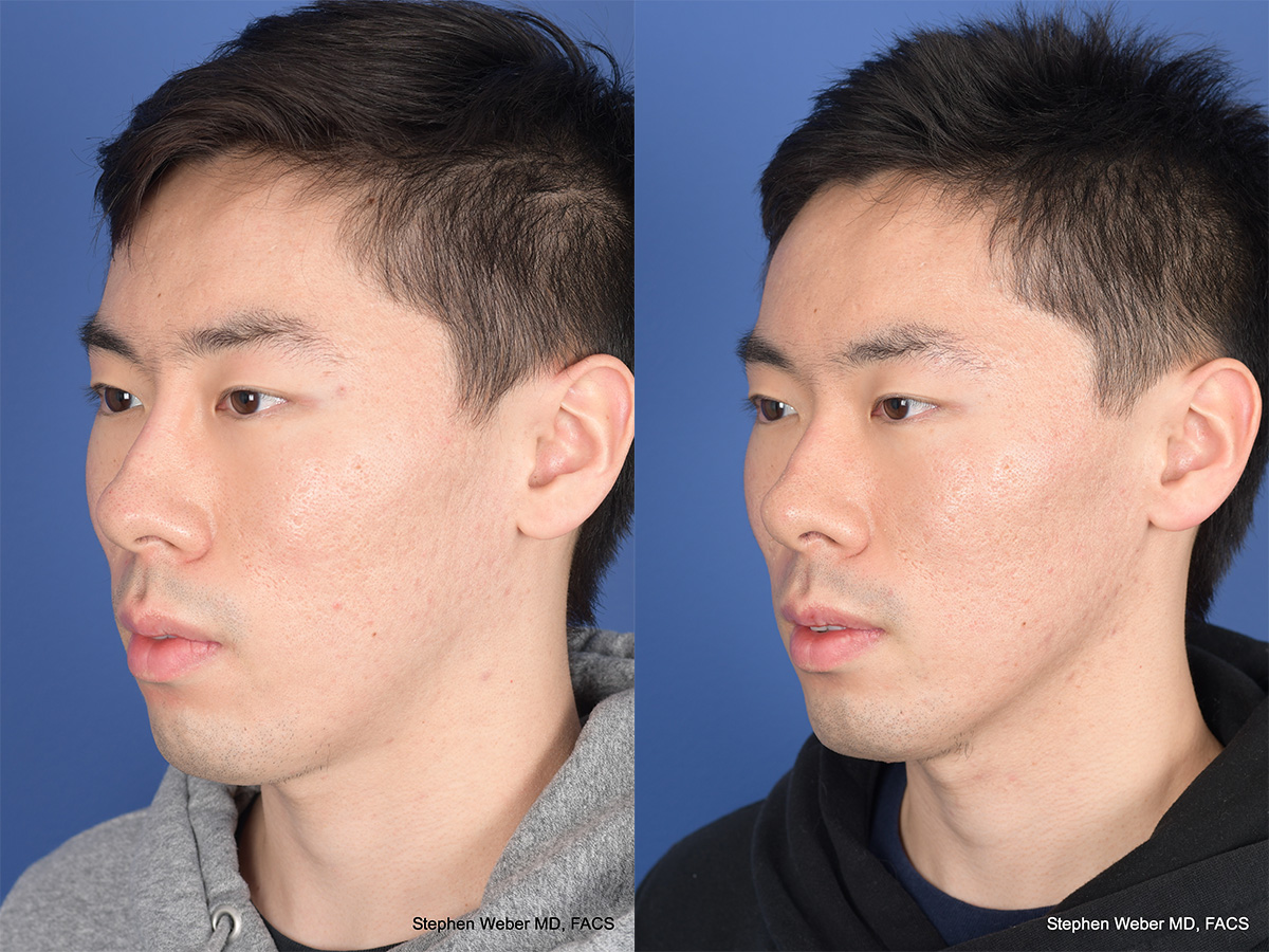 Revision Rhinoplasty Before and After | Weber Facial Plastic Surgery