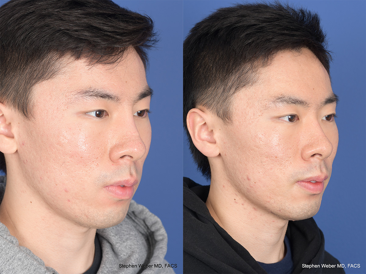 Revision Rhinoplasty Before and After | Weber Facial Plastic Surgery