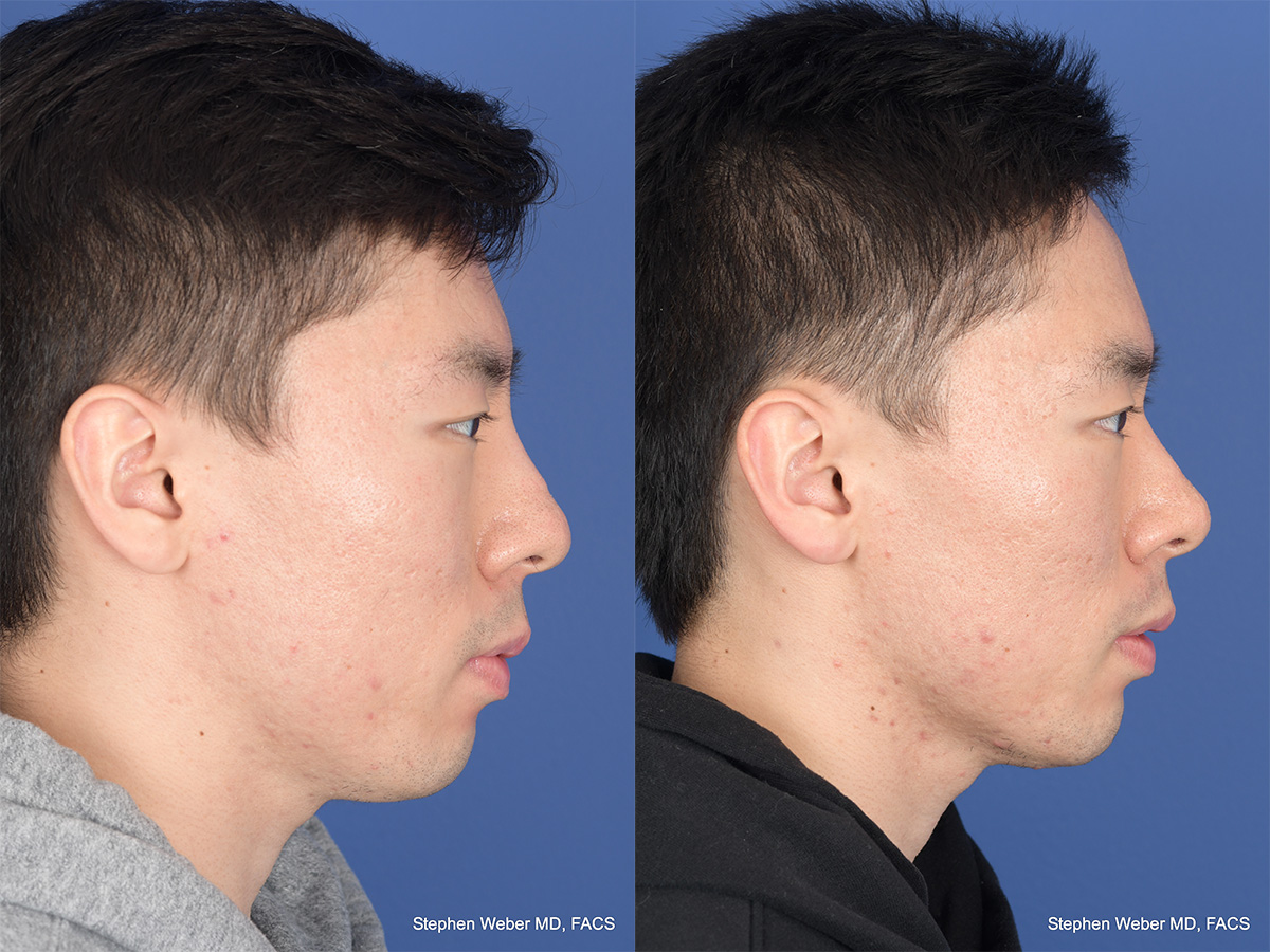 Revision Rhinoplasty Before and After | Weber Facial Plastic Surgery