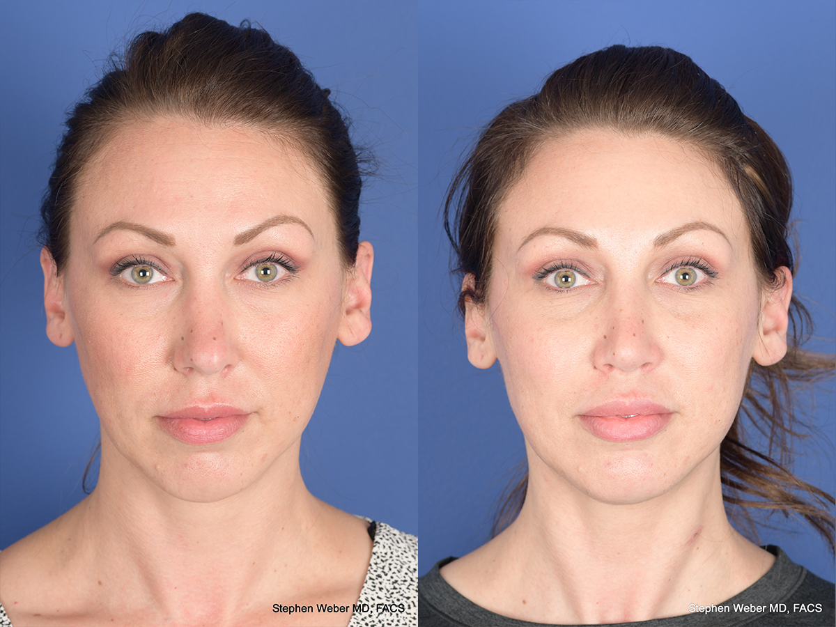Revision Rhinoplasty Before and After | Weber Facial Plastic Surgery