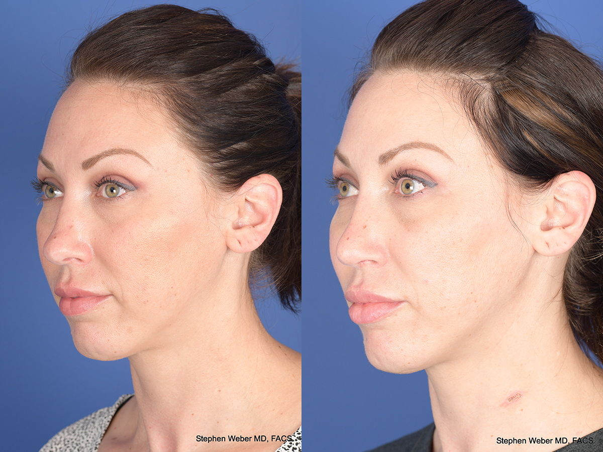 Revision Rhinoplasty Before and After | Weber Facial Plastic Surgery