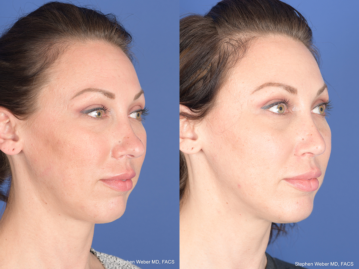 Revision Rhinoplasty Before and After | Weber Facial Plastic Surgery