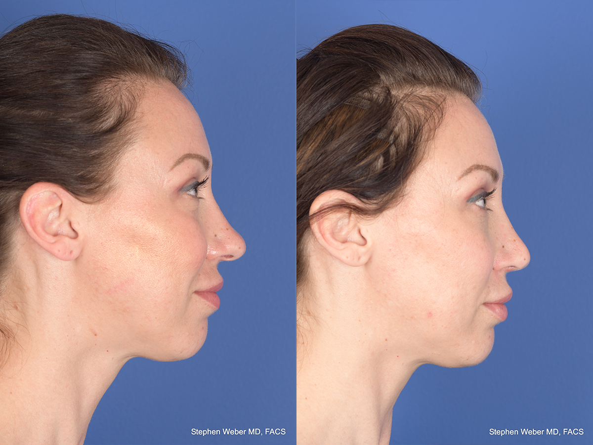 Revision Rhinoplasty Before and After | Weber Facial Plastic Surgery