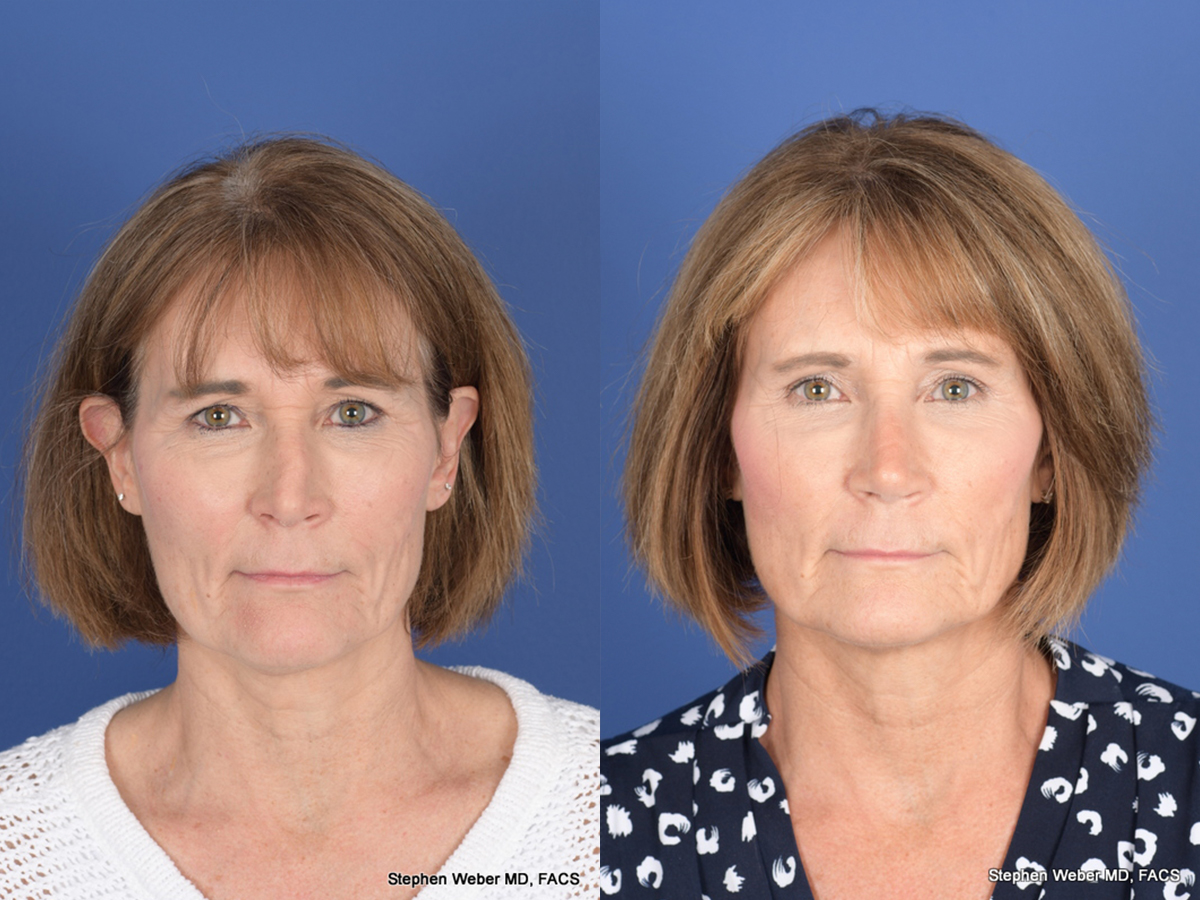 Revision Rhinoplasty Before and After | Weber Facial Plastic Surgery