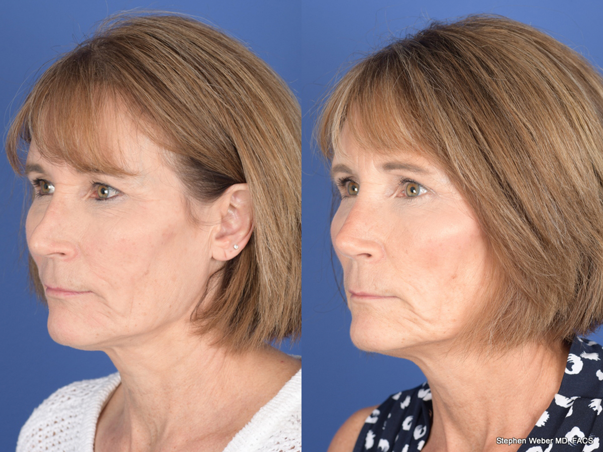 Revision Rhinoplasty Before and After | Weber Facial Plastic Surgery