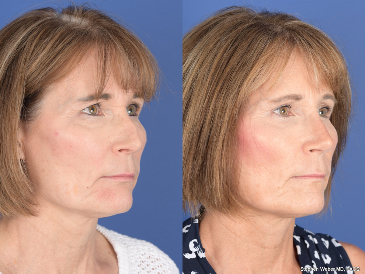Revision Rhinoplasty Before and After | Weber Facial Plastic Surgery