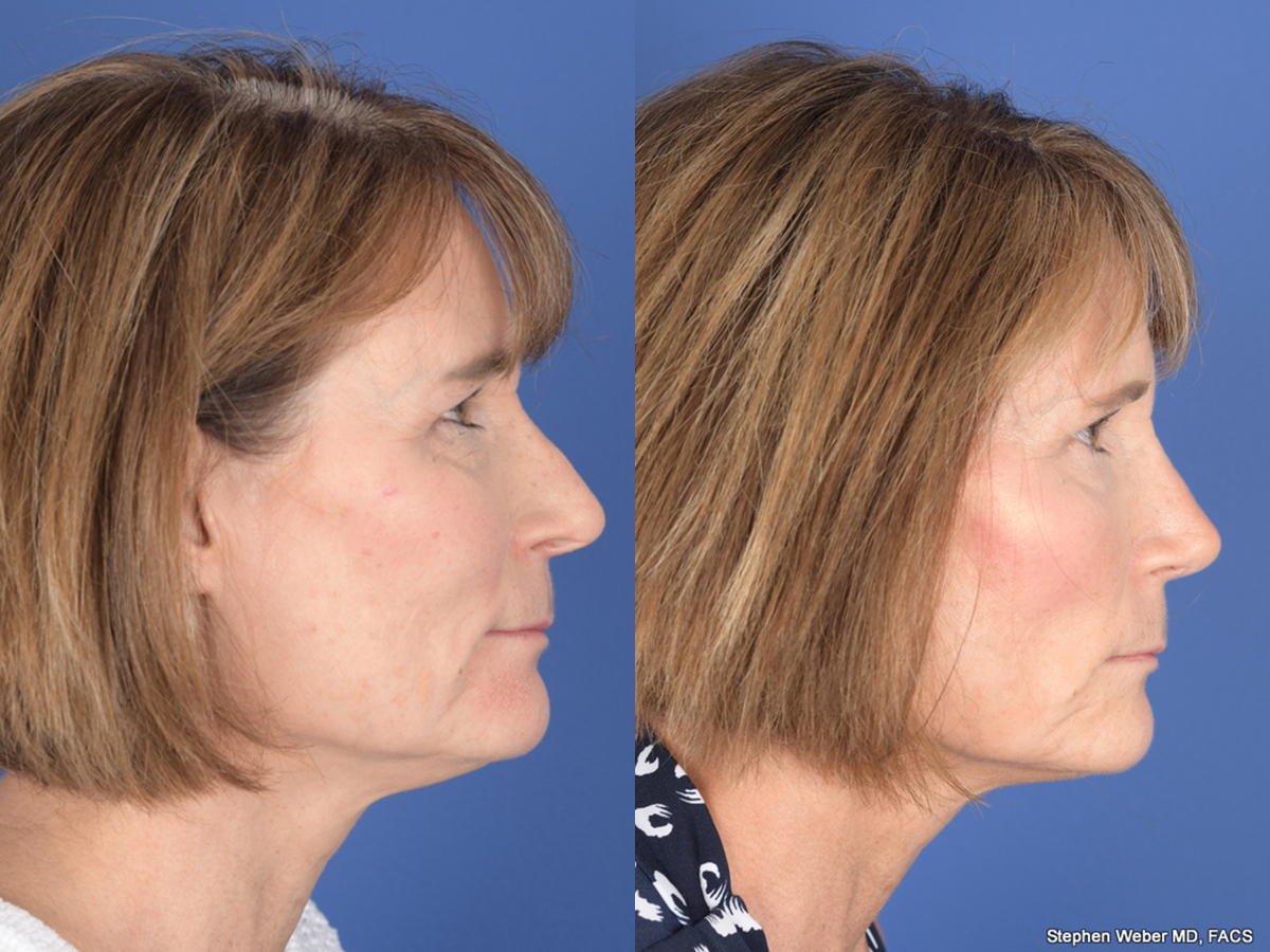 Revision Rhinoplasty Before and After | Weber Facial Plastic Surgery