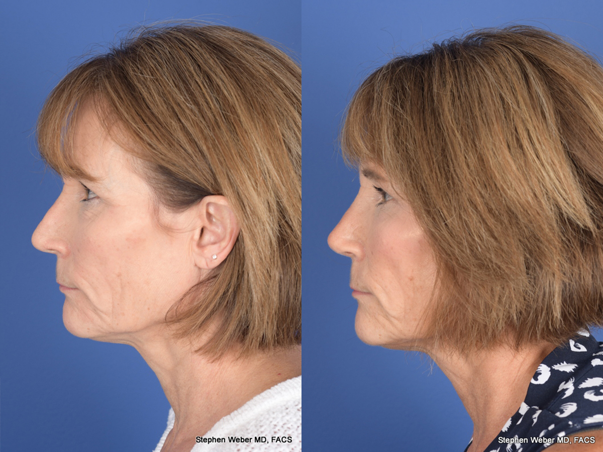 Revision Rhinoplasty Before and After | Weber Facial Plastic Surgery