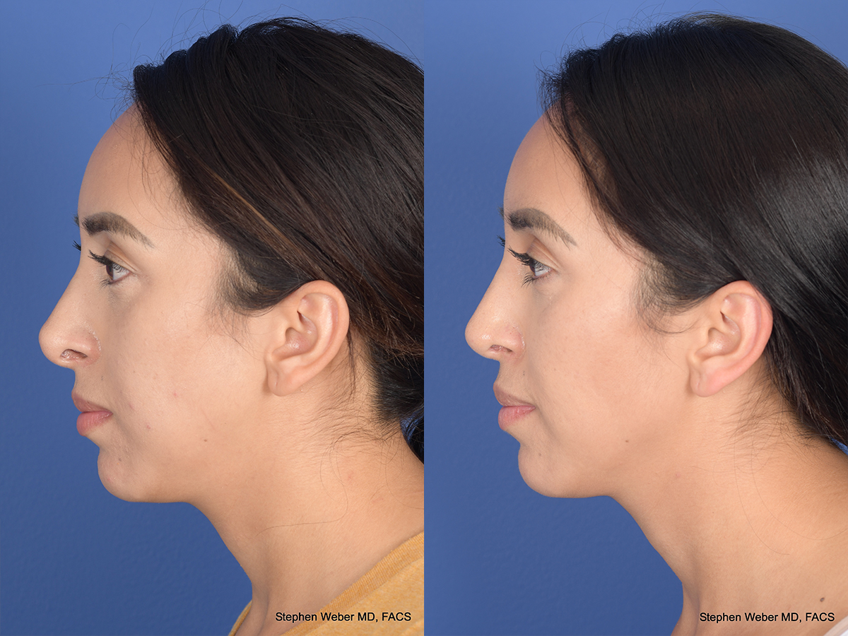 Revision Rhinoplasty Before and After | Weber Facial Plastic Surgery