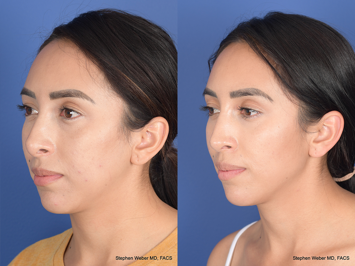 Revision Rhinoplasty Before and After | Weber Facial Plastic Surgery