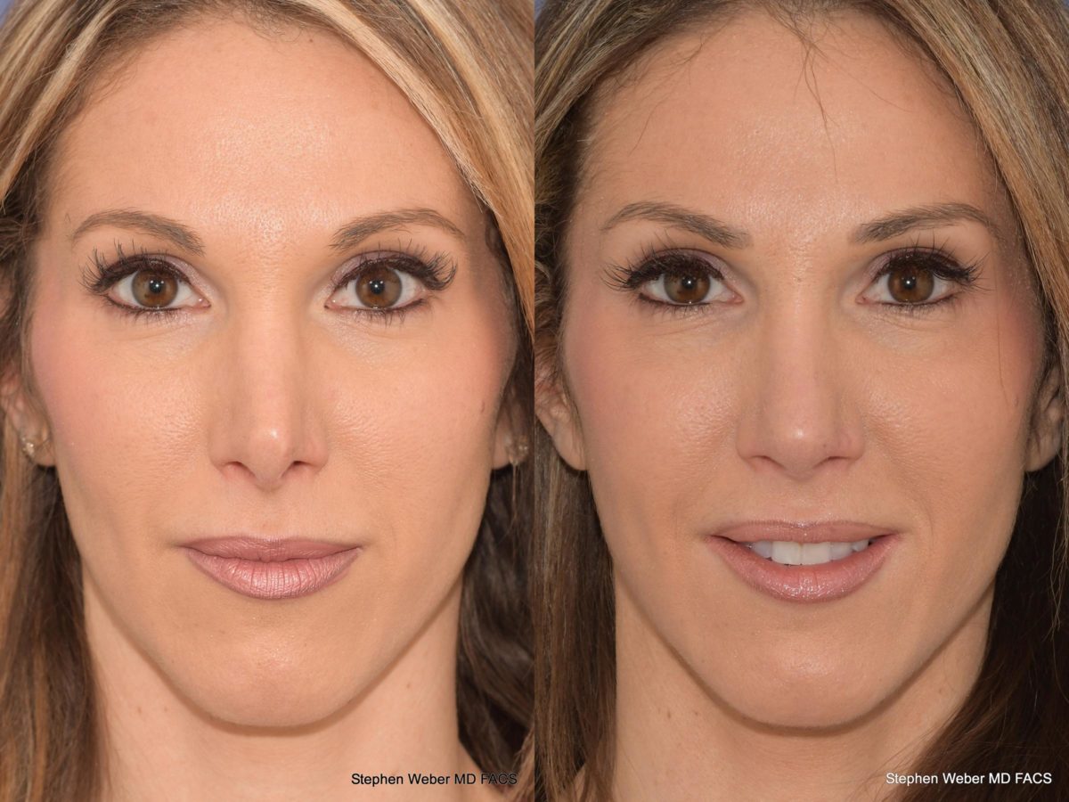 Revision Rhinoplasty Before and After | Weber Facial Plastic Surgery