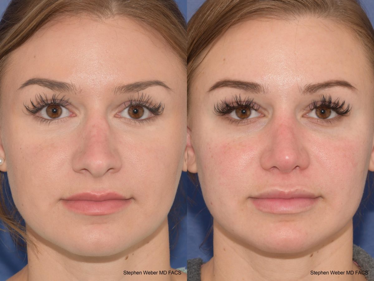 Revision Rhinoplasty Before and After | Weber Facial Plastic Surgery
