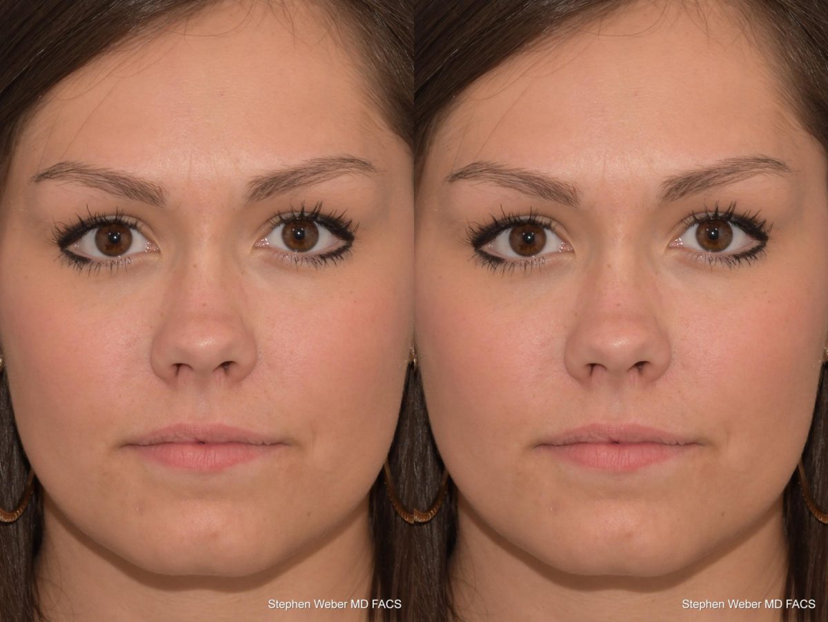 Revision Rhinoplasty Before and After | Weber Facial Plastic Surgery