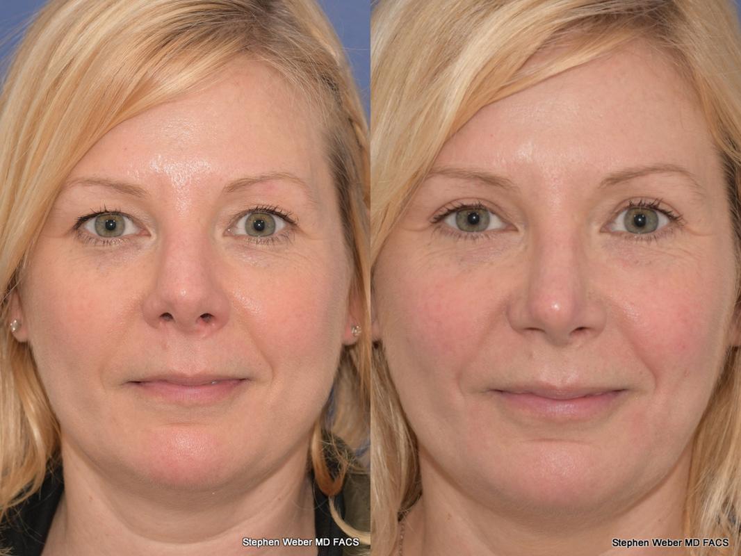 Revision Rhinoplasty Before and After | Weber Facial Plastic Surgery