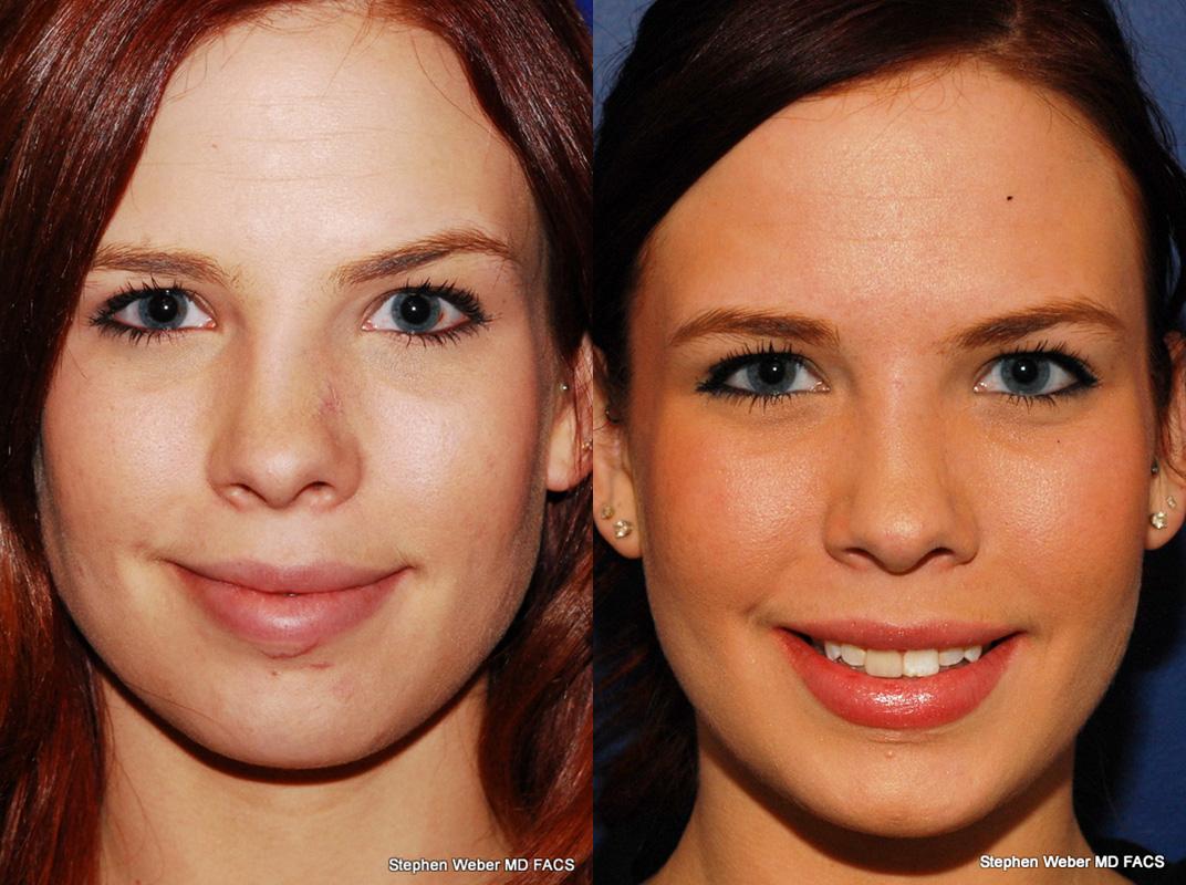 Revision Rhinoplasty Before and After | Weber Facial Plastic Surgery