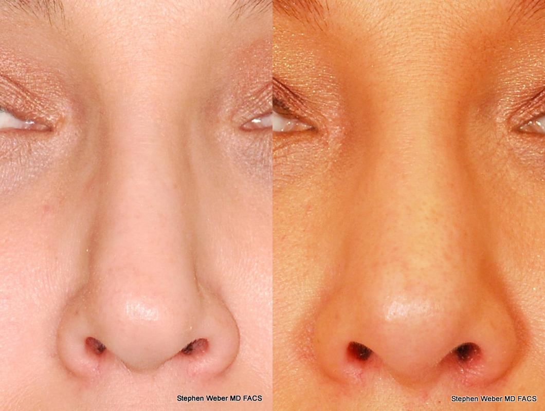 Revision Rhinoplasty Before and After | Weber Facial Plastic Surgery