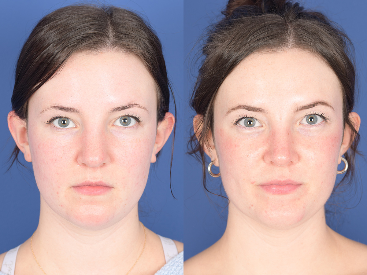Rhinoplasty Before and After | Weber Facial Plastic Surgery