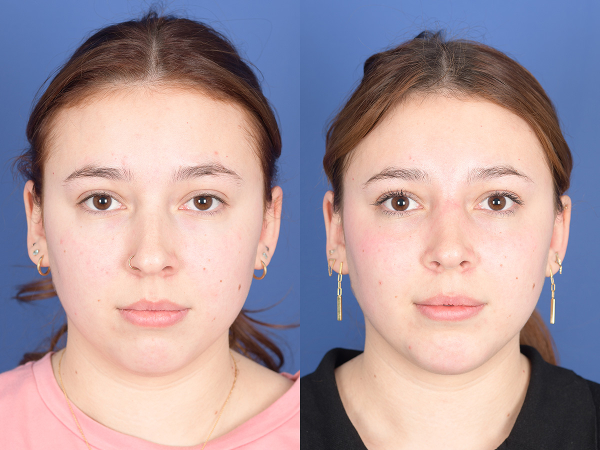 Rhinoplasty Before and After | Weber Facial Plastic Surgery