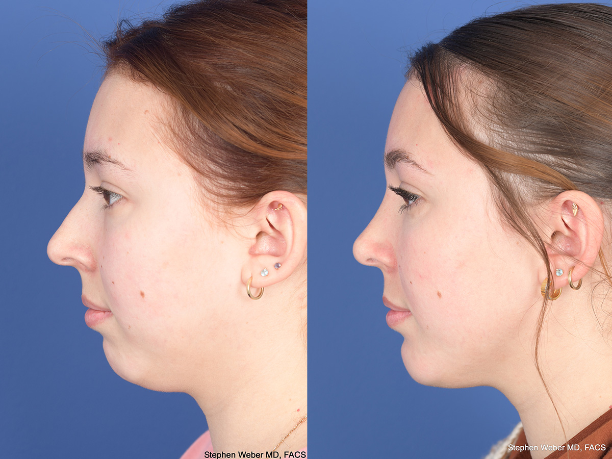 Rhinoplasty Before and After | Weber Facial Plastic Surgery