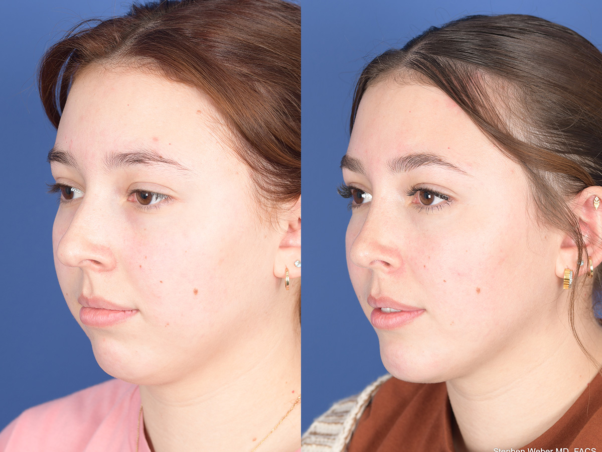 Rhinoplasty Before and After | Weber Facial Plastic Surgery