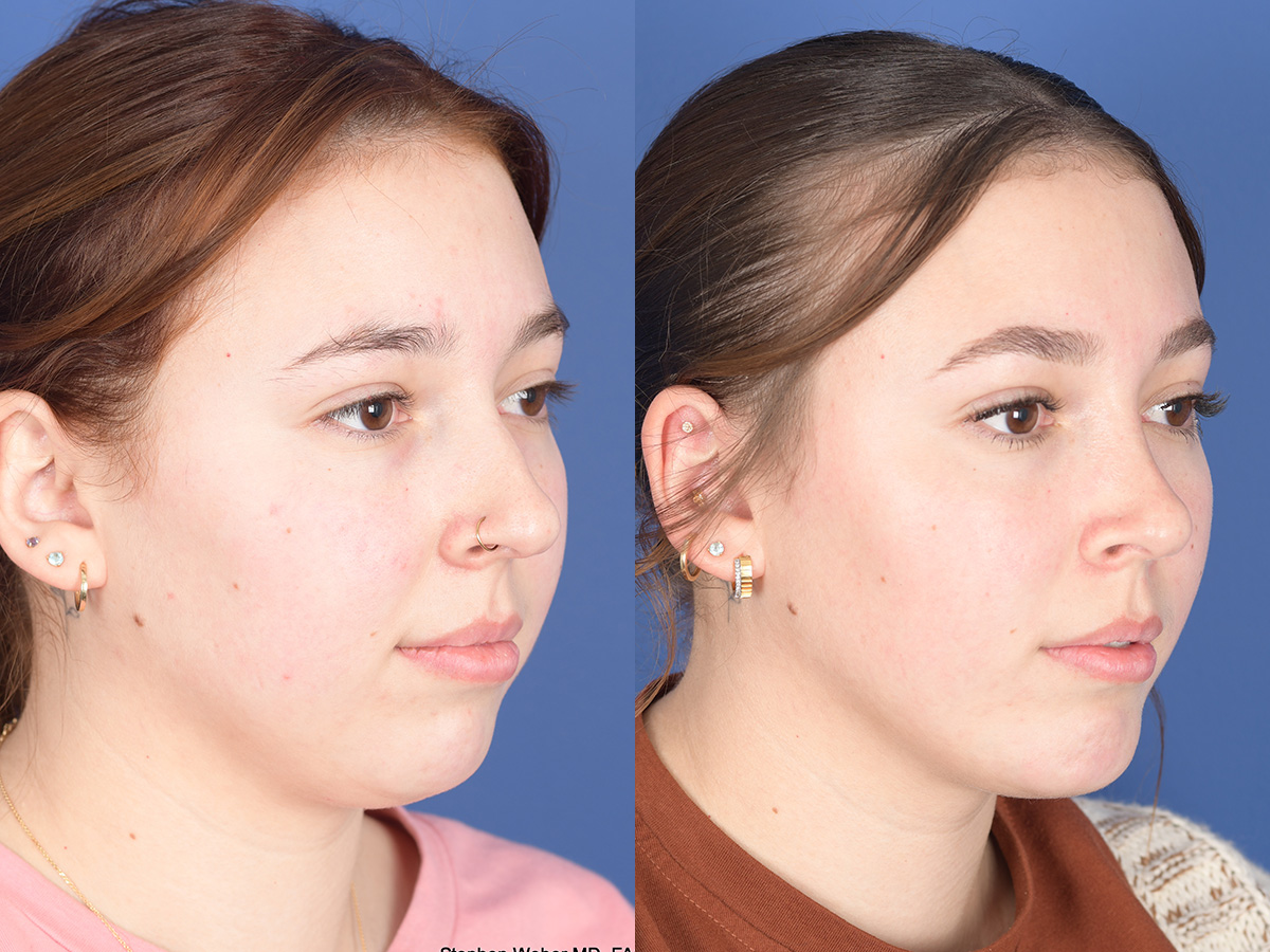 Rhinoplasty Before and After | Weber Facial Plastic Surgery