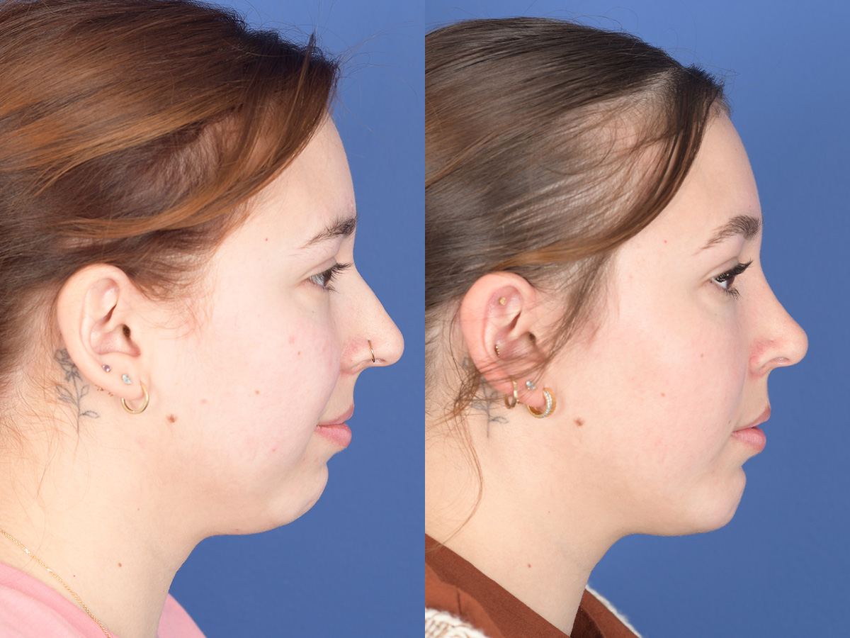 Rhinoplasty Before and After | Weber Facial Plastic Surgery