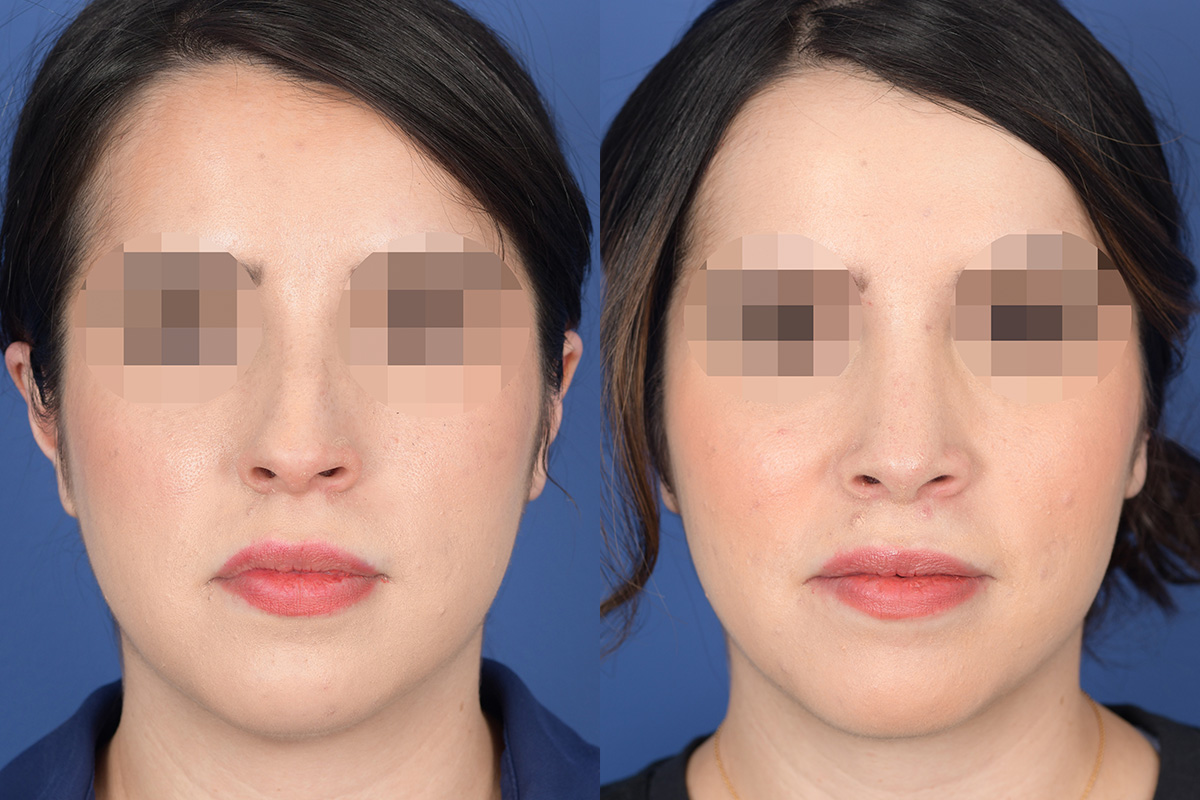Before and After Rhinoplasty in Denver 1